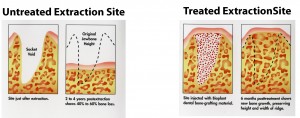 bone graft