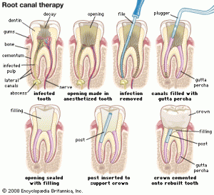 root-canal[1]